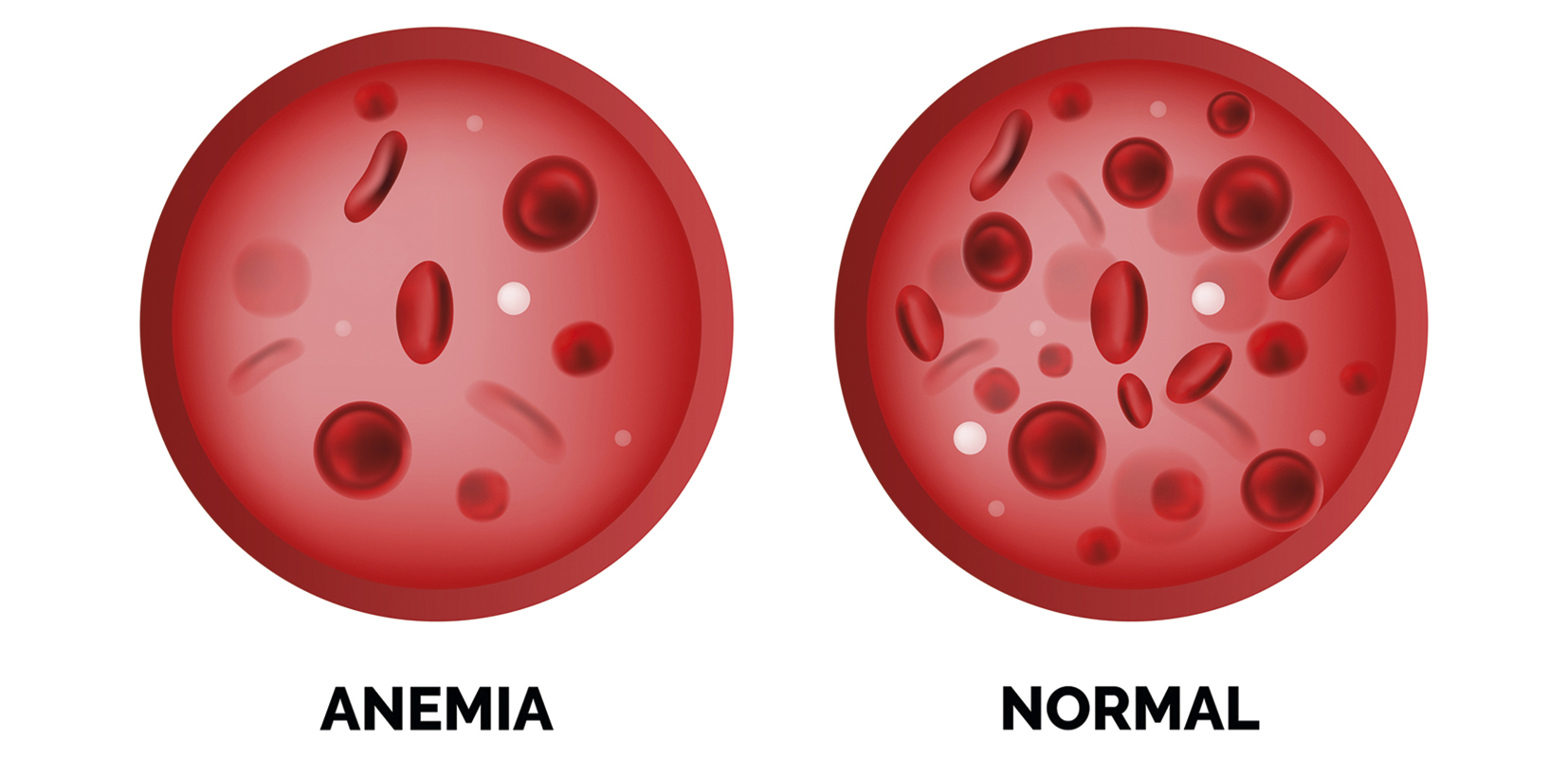 imagen glóbulos rojos con anemia