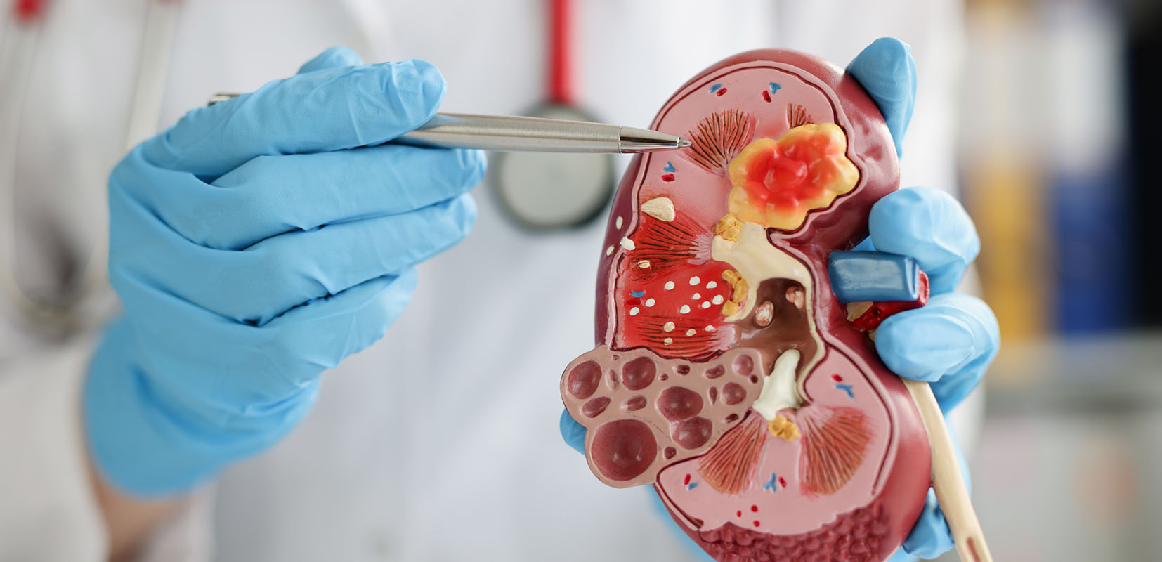 Urólogo mostrando maqueta de un riñon